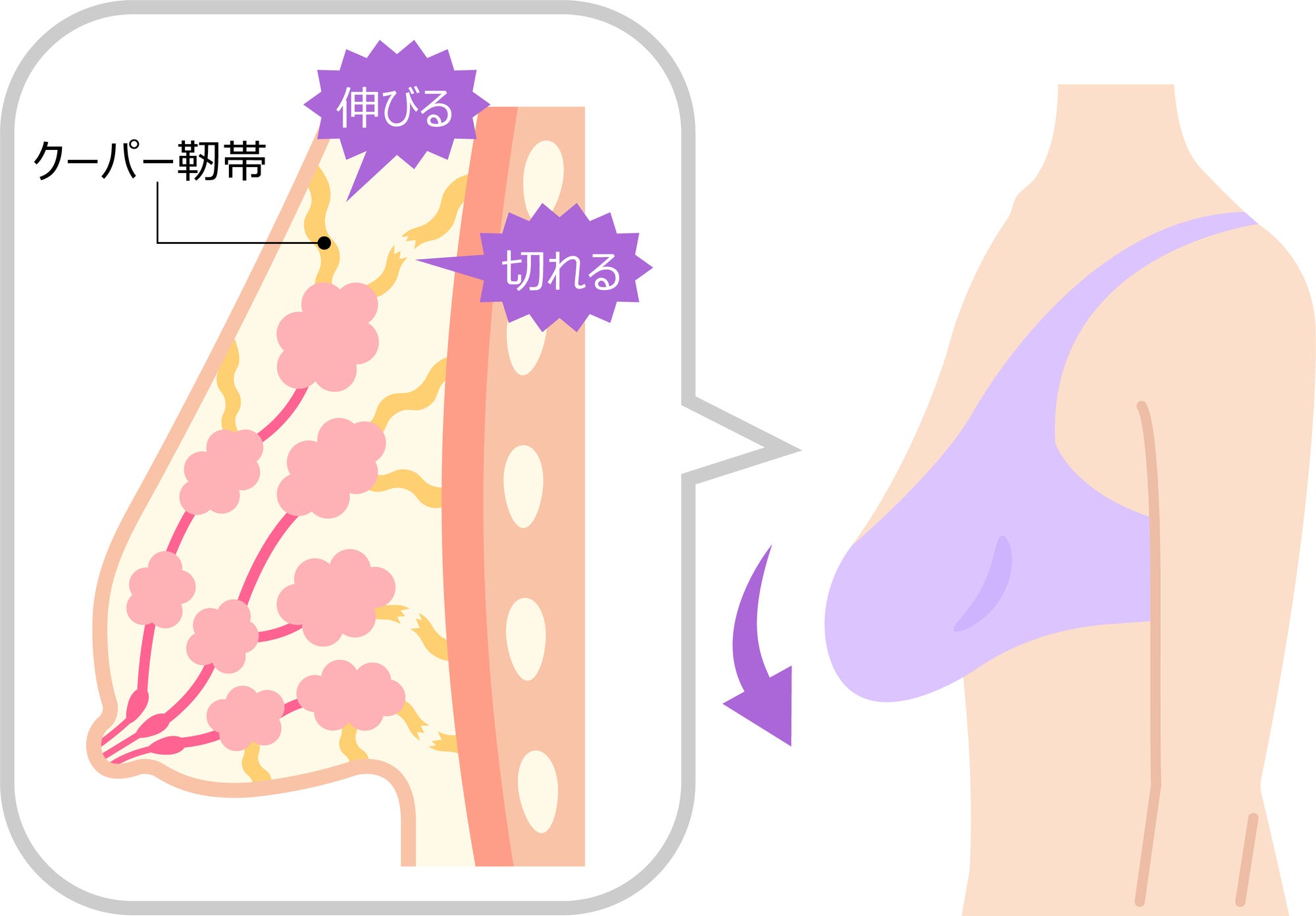 バスト　崩れ